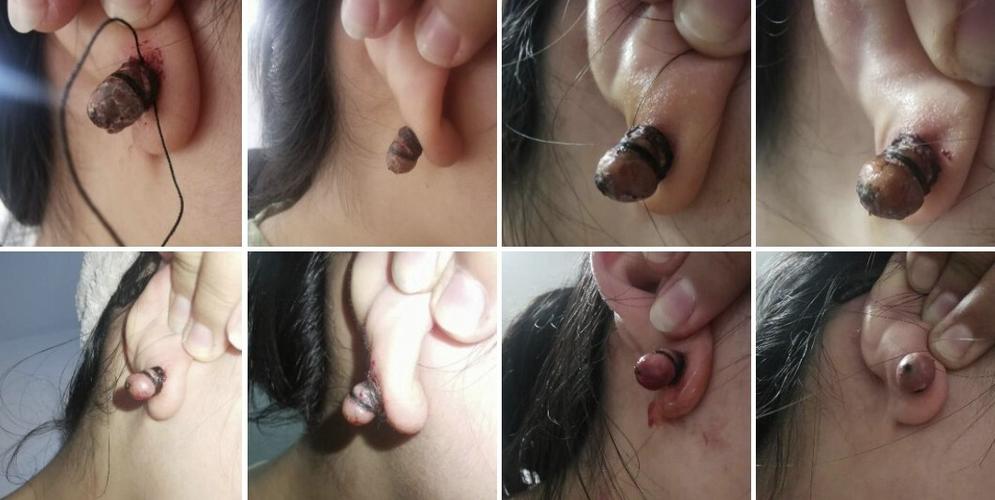 扎耳洞 瘢痕疙瘩_耳洞_医疗健康_医疗健康其他