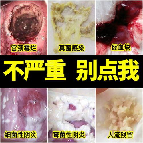 妇科炎症凝胶阴道炎治疗中重度宫颈糜烂用要女白带异味霉菌滴虫姓