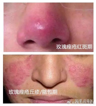 【详细带解决方法】面部脂溢性皮炎的解决方案|皮肤科