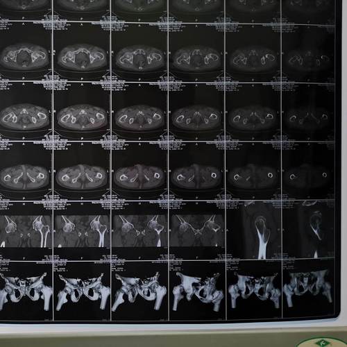 双髋关节ct示:左股骨颈骨折