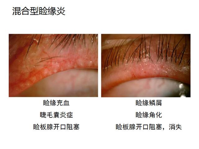 眼睑缘炎的原因及治疗