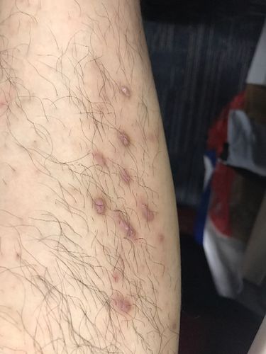 腿上长了这种疙瘩,快有一年了吧,有时候会有点痒,这个怎么样会好啊