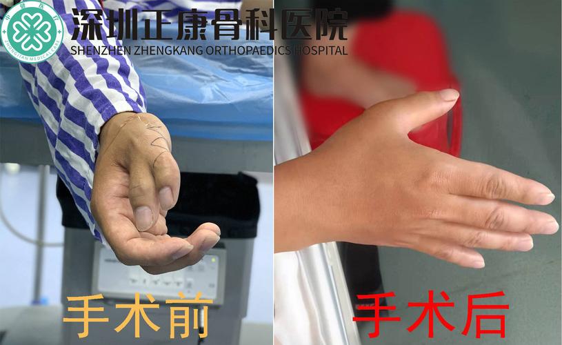 深圳六指畸形怎么办?骨科医院手术切除