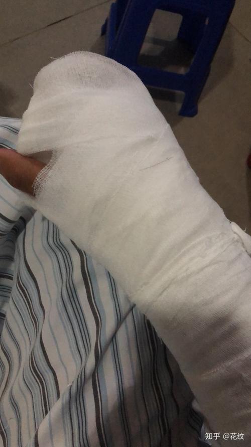 手腕舟骨骨折经历