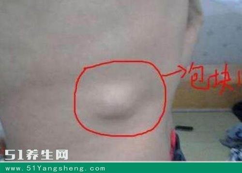 身上长这样的包块儿,可能是恶性肿瘤