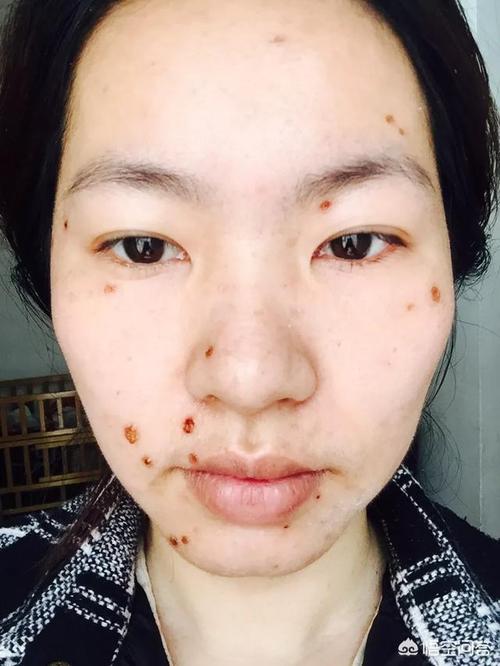点痣需要注意什么