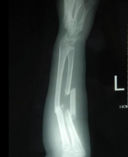 手臂左尺桡骨多段粉碎性骨折