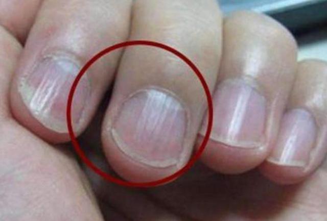 是缺钙吗?指甲异常说明了
