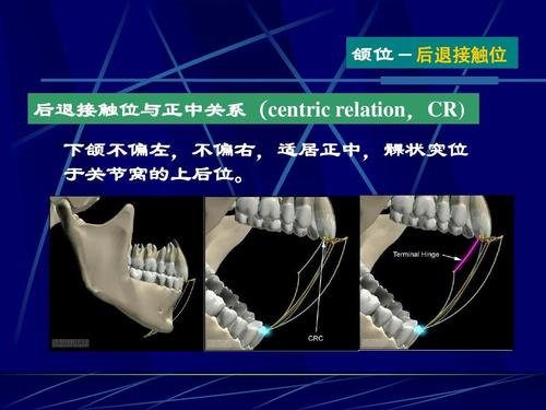 颌位-后退接触位 后退接触位与正中关系(centric relation,cr) 下颌不