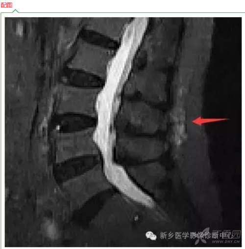 教你用磁共振看腰肌劳损(转载)