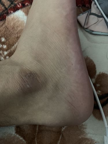 脚踝的皮变硬这是什么情况?