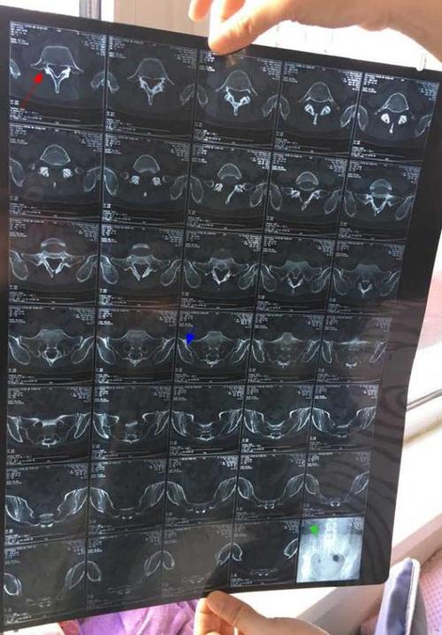 29,两月前腰底疼ct为骶髂关节炎,后右腿疼屁股痛做了核磁,腰45腰5骶1