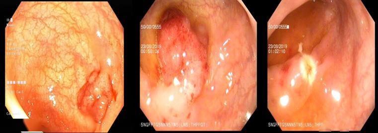 湘潭市中医医院肛肠科在肠镜下开展大肠息肉内镜下注射粘膜切除术