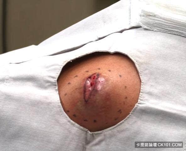 手上起了手肘一样的脓包,医师竟然选择用刀切开