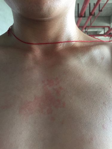 请问我皮肤怎么 就胸口这一块有 而且有差不多一年了