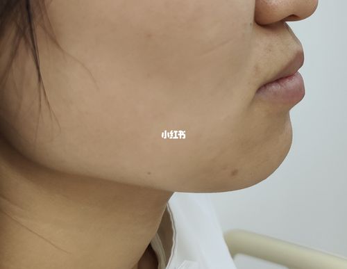 为什么打玻尿酸要做颏肌放松