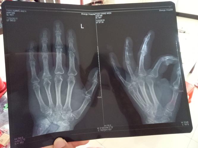 左手无名指近节指骨基底部横行骨折复查,正位,断端对位对线良好