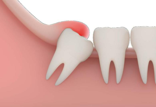 深圳拔智齿本来就胖拔完智齿还肿那还有必要拔智齿吗