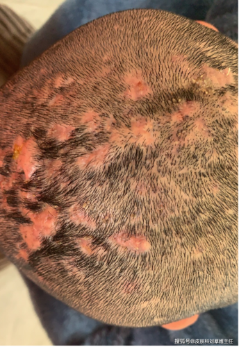 但它却不是普通的毛囊炎,而是一种 穿掘性蜂窝织炎,又称化脓性头部穿