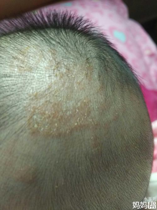 宝宝头上长了红色点点,求解决办法!