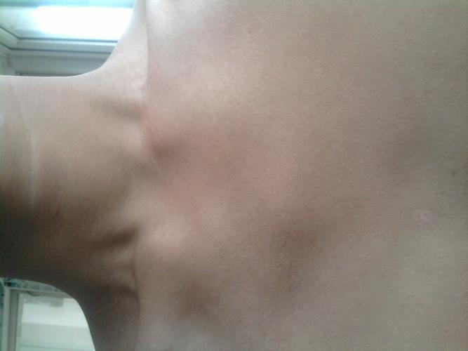 肋骨那凹陷 显得胸骨角突出