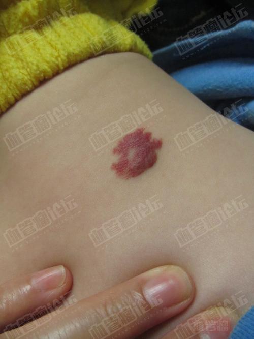 五种血管瘤的临床表现有哪些?