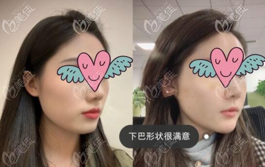 下颌缘凹陷填充脂肪30天对比照片,脸变方和下巴变宽难看不可信!