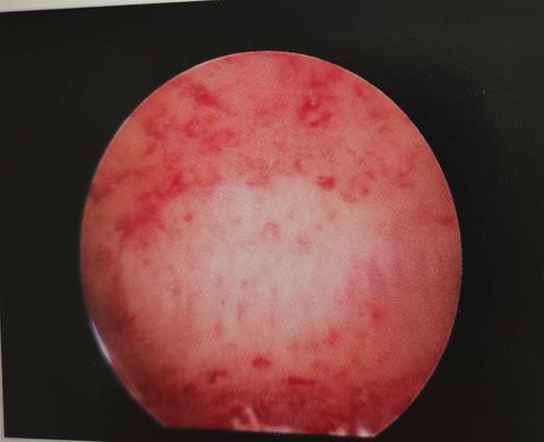 宫腔镜下的子宫