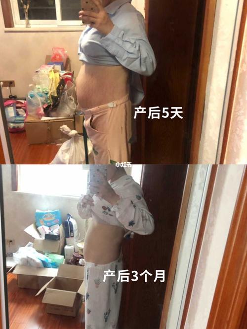 生完孩子的肚子没眼看!产后恢复不变丑!