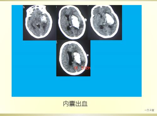 脑出血的ct诊断