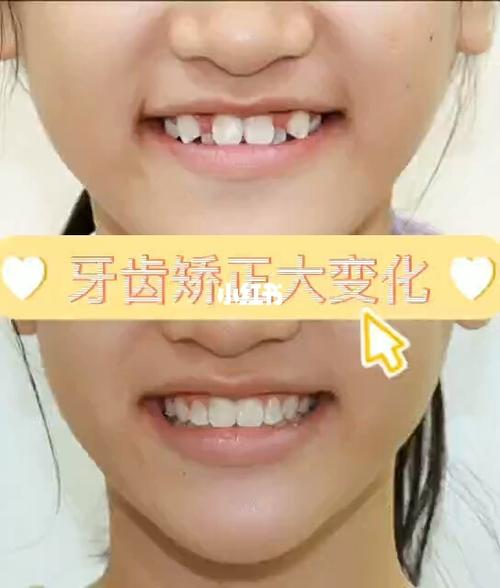 真人牙齿矫正变化过程曝光_口腔_牙齿矫正_美妆_医美