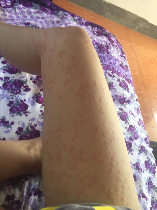 荨麻疹一个月了,吃盐酸西替利秦片,皮肤病血毒丸,氯雷