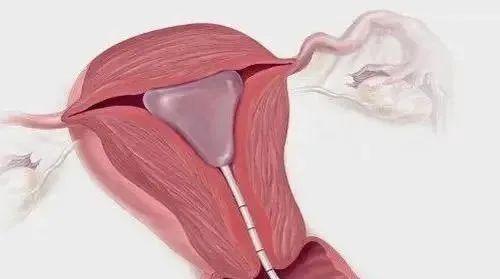 一旦确诊为宫腔粘连,应积极配合医生的治疗,尽可能地将子宫内膜的损害