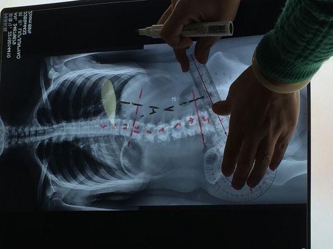 2018首发钟妍老师asap私教体系脊柱侧弯纠正课程圆满结束