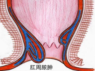 肛门脓肿