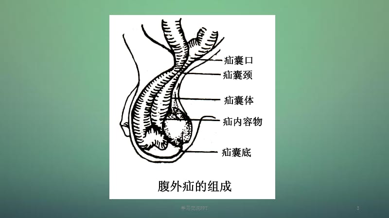 腹外疝新版ppt课件