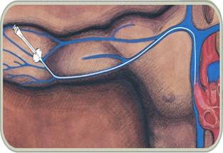 picc导管维护及并发症护理