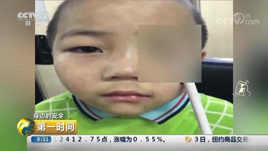 [视频]男童摔倒笔尖戳眼险失明