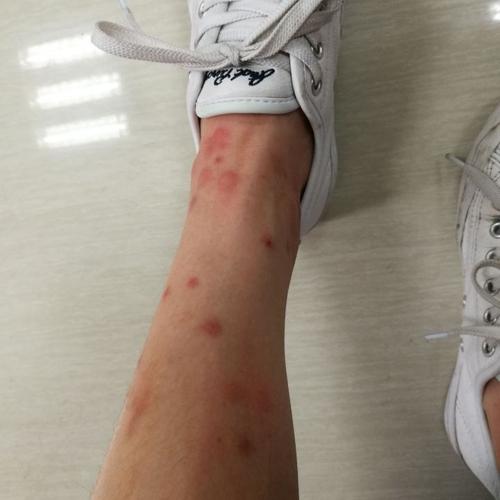 被跳蚤咬了怎么办,家里跳蚤多该如何灭杀?