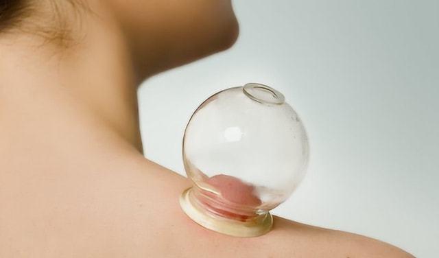 拔火罐时,后背出现瘀血,是排出的毒素吗?看完长知识了