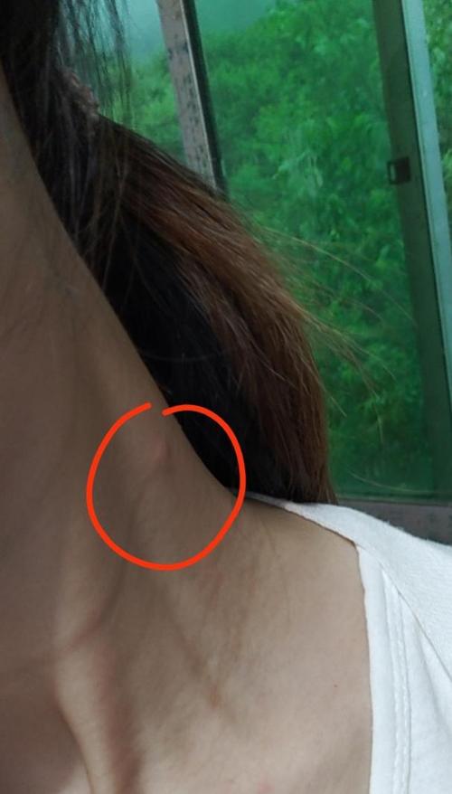 右侧脖子长了个凸起的颗粒怎么回事