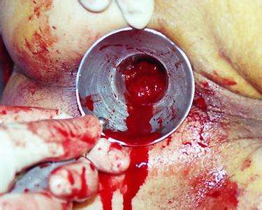 内痔去医院都检查啥