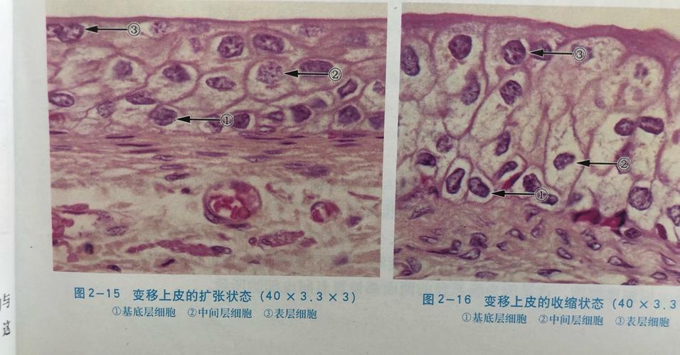 变移上皮的扩张状态shift of epithelium expanded state