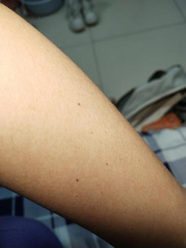 妈妈去问过皮肤科的医生,好像说是紫癜什么的?