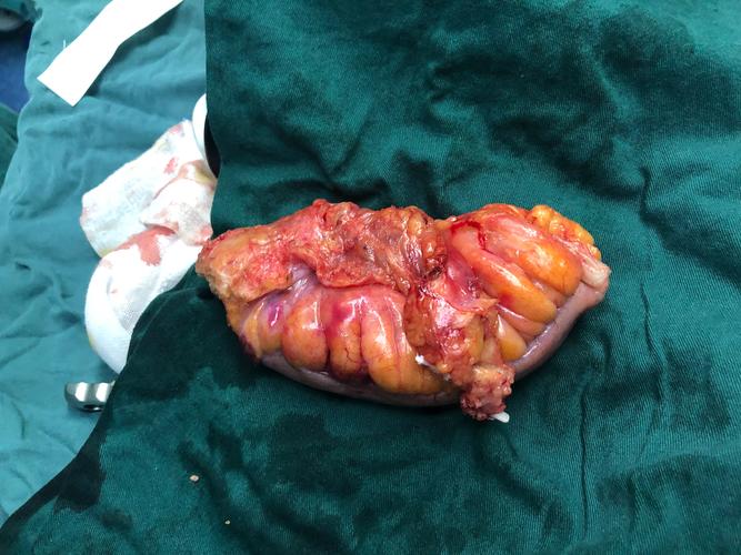 中国医科大学附属盛京医院/结直肠肿瘤外科/张宏教授/单孔腹腔镜直