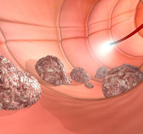 这些排便异常可能是结肠癌的早期预警,上完厕所记得回头看一眼