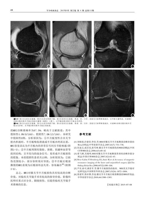 膝关节半月板损伤mri诊断与关节镜对比研究