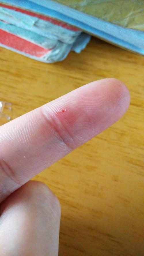 昨天不小心被野猫抓伤了,伤口不大,但是流了点血,那只