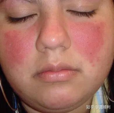 急性皮肤型红斑狼疮