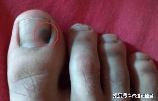 若手发出这些"信号",可能"肺癌"已偷偷上门